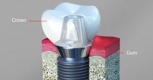 dental implants dentist Timonium MD