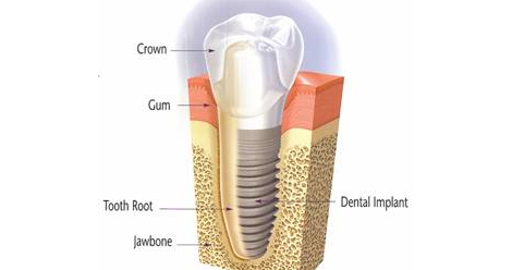 dental implants dentist Timonium MD