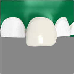 porcelain veneers for teeth with a Timonium dentist Towson MD