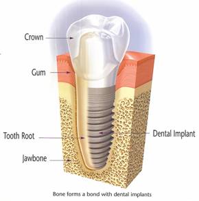 tooth implant in Timonium and Pikesville