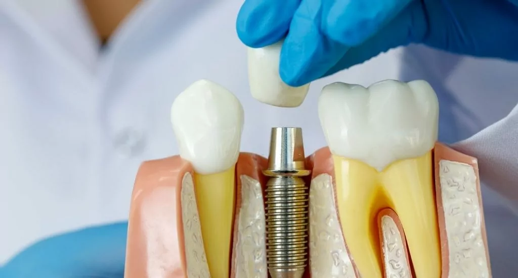 Dental Implant Procedures