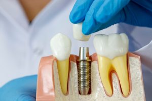 Dental Implant Procedures