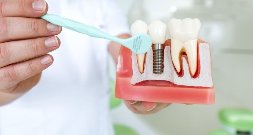 What Are Dental Implants