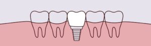dental implants Timonium