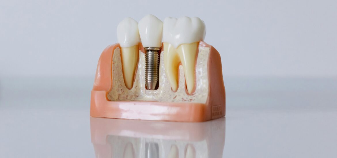 Dental implant